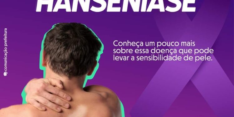 Janeiro Roxo alerta para a conscientização da Hanseníase