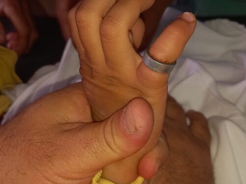Criança de quatro anos fica com rolamento de aço preso no dedo