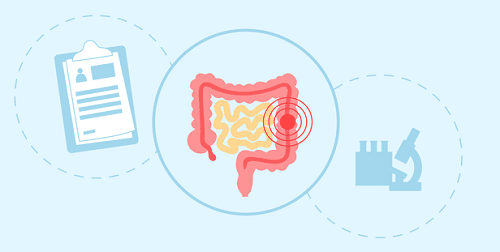Câncer de intestino: 5 fatos que você precisa saber sobre o câncer de cólon e reto