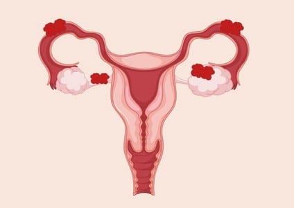 As 5 principais dúvidas das mulheres sobre a endometriose